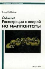 Мюльхойзер (Mühlhäuser) - Съемные реставрации с опорой на имплантаты